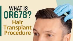 Want to Get Hair Transplant? QR 678 Hair Transplant, Basic Procedure, Side Effects And More Explained