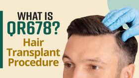 Want to Get Hair Transplant? QR 678 Hair Transplant, Basic Procedure, Side Effects And More Explained