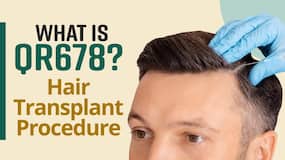 Want to Get Hair Transplant? QR 678 Hair Transplant, Basic Procedure, Side Effects And More Explained