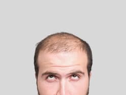 Baldness At A Young Age: Why Is It A Rising Concern These Days?