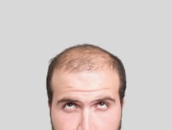 Baldness At A Young Age: Why Is It A Rising Concern These Days?