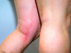 Phlebitis and Thrombophlebitis: COVID-19 complications that may strike people with genetic risk of clotting