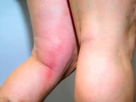 Phlebitis and Thrombophlebitis: COVID-19 complications that may strike people with genetic risk of clotting