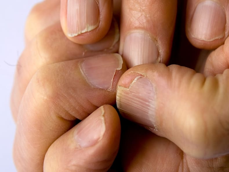 Your Nails Tell A Lot; They Can Even Indicate If You Are Suffering From A Vitamin Deficiency