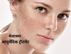 Hyperpigmentation: मेलास्‍मा के संकेत हैं चेहरे व गर्दन पर होने वाले काले धब्‍बे, जानिए इस हाइपरपिग्मेंटेशन का आयुर्वेदिक उपचार