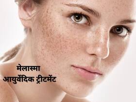 Hyperpigmentation: मेलास्‍मा के संकेत हैं चेहरे व गर्दन पर होने वाले काले धब्‍बे, जानिए इस हाइपरपिग्मेंटेशन का आयुर्वेदिक उपचार