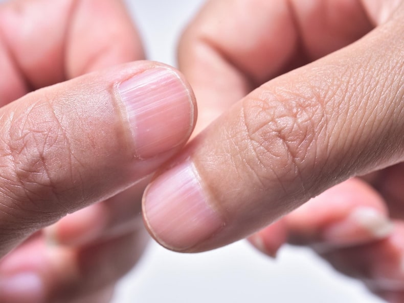 Your Nails Tell A Lot; They Can Even Indicate If You Are Suffering From A Vitamin Deficiency