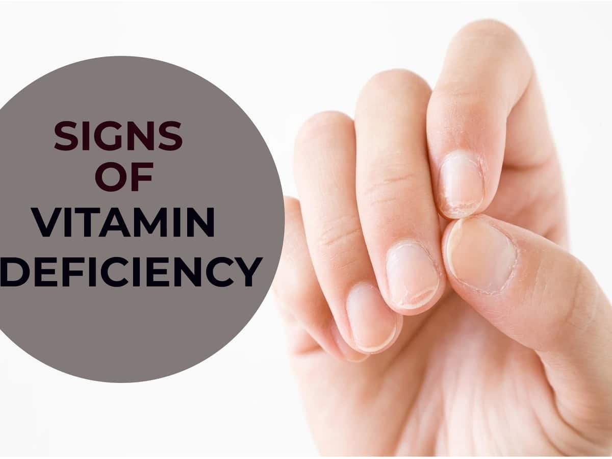 Your Nails Can Tell If You Are Suffering From A Vitamin Deficiency |  