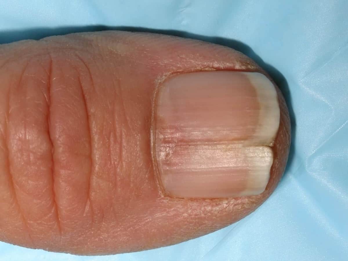 Why does a brown line appear on a fingernail? - Quora