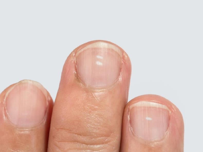 Your Nails Tell A Lot; They Can Even Indicate If You Are Suffering From A Vitamin Deficiency