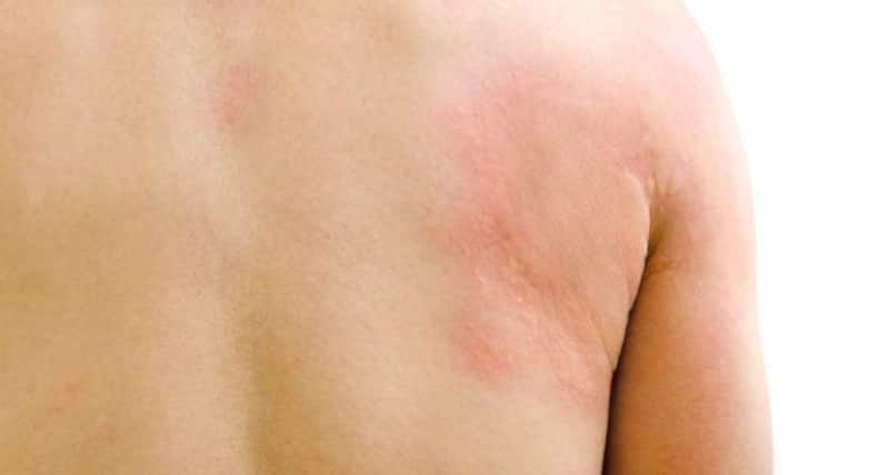 Do You Experience Frequent Infections? It’s A Common Blood Cancer Symptom