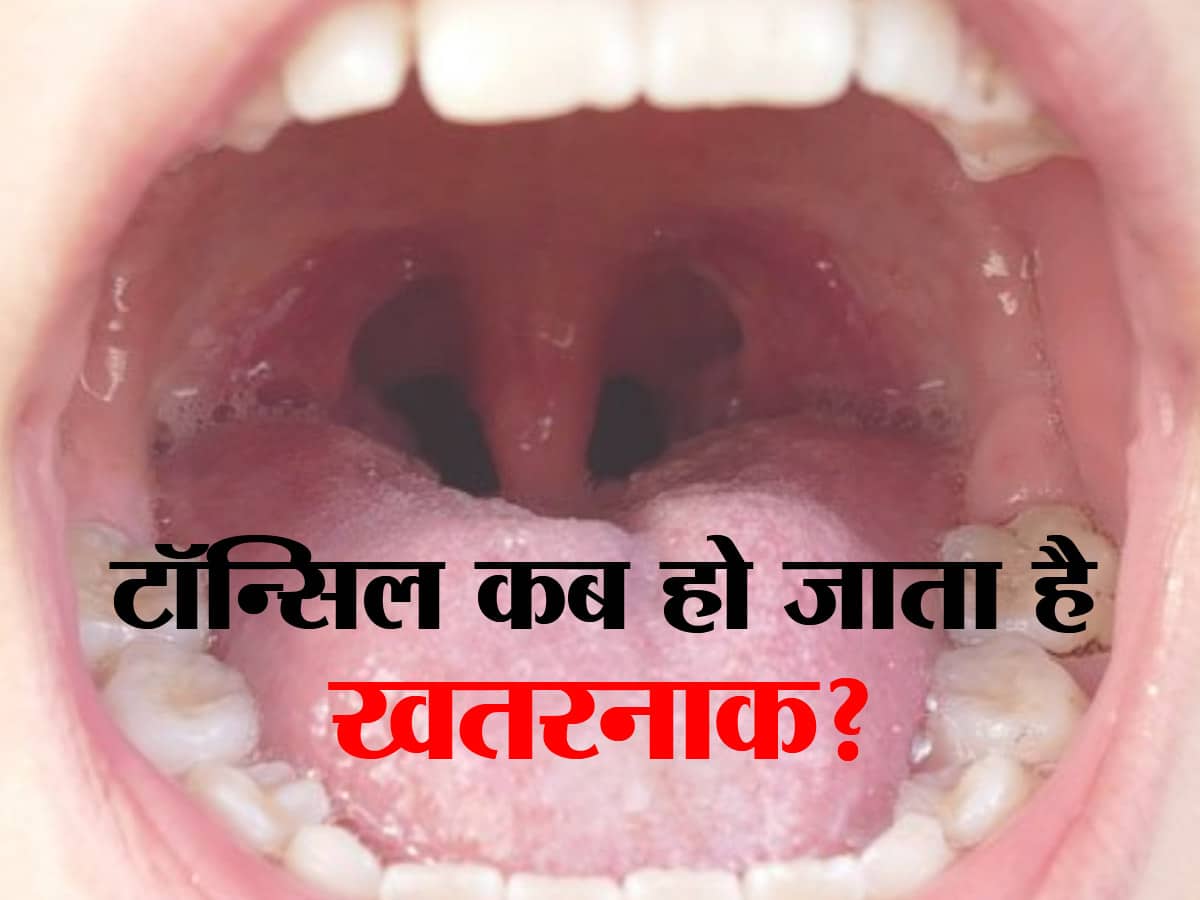 Tonsils Prevention tips in hindi टॉन्सिल होने पर कब डॉक्टर को दिखाने