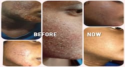 Psoriasis Treatment: The Role Of Detoxification, Nutrition And Oxygenation