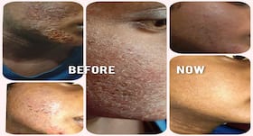 Psoriasis Treatment: The Role Of Detoxification, Nutrition And Oxygenation