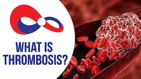 World Thrombosis Day 2021 : What Is Thrombosis? Symptoms, Causes, Treatment & More