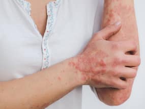 World Psoriasis Day 2021: सोरायसिस के एक तिहाई रोगियों को डिप्रेशन, एंग्‍जायटी होने की संभावना, जानें इसका एडवांस उपचार