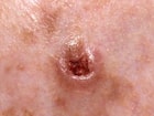 Basal Cell Carcinoma