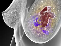 Obesity May Increase Risk Off Breast Cancer By Almost 40%: Lose Weight Before It Is Too Late