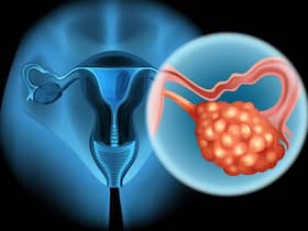 Gynaecological Cancer: Awareness Is Key To Advocating For Women   s Health