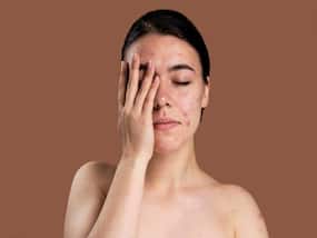 Got Psoriasis? Here's How It Can Get Worse If Left Untreated