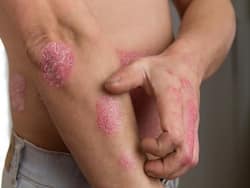 World Psoriasis Day 2021: Is Taking COVID Vaccines Safe for Psoriasis Patients?