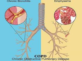 World COPD Day 2021: Why Chronic Obstructive Pulmonary Diseases Deserves Our Attention