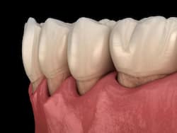 Receding Gums Treatment: मसूड़ों में ढीलापन का कारण हैं ये 7 बीमारियां, इन 3 आयुर्वेदिक तरीकों से कर सकते हैं उपचार