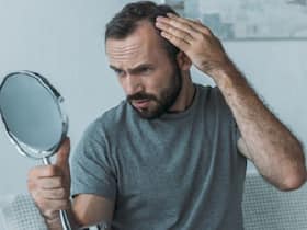 7 Ways Men Can Tackle Severe Hair Loss