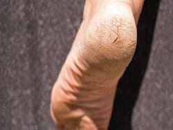 सर्दियों में फटी एड़ियों की समस्या को दूर करेंगे ये 2 होममेड पैक