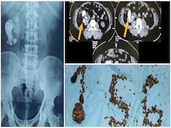 हैदराबाद के हॉस्पिटल में मरीज की किडनी से निकाली गईं 156 पथरियां, दिखें जब ये 10 लक्षण तो गुर्दे की कराएं जांच