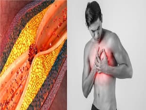 Omega-3 Fatty Acids Can Help Reduce Atherosclerosis, Prevent Cardiovascular Disease