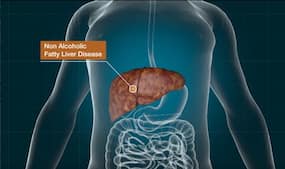Fatty Liver Diseases: Make Gooseberry Aka Amla a Part of Your Daily Diet To Fight Hepatic Steatosis