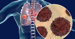 Lung Cancer: Bloody Mucus And Other Common Signs Of Cancer In Your Cough That Indicates Emergency