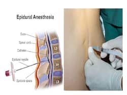 Epidurals For Labour Pain Relief: Get To Know The Benefits And Side Effects