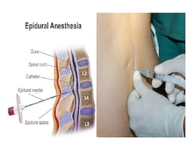 Epidurals For Labour Pain Relief: Get To Know The Benefits And Side Effects