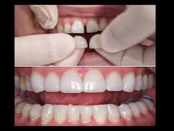 Dental Veneers: An Option For A Better Smile
