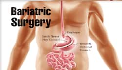 Undergone Bariatric Surgery? Doctor Explains The Importance of Psychological Support That You May Need