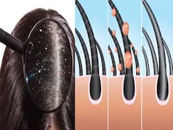 सर्दियों में स्कैल्प को डैंड्रफ से बचाने के लिए अपनाएं ये 3 आसान उपाय, बाल भी होंगे शाइनी-हेल्दी