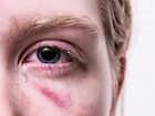 काला मोतियाबिंद (Glaucoma)