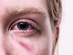 काला मोतियाबिंद (Glaucoma)