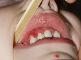 Gum Disease Can Increase Risk Of Developing Cardiovascular Disease, Mental Illness: Study