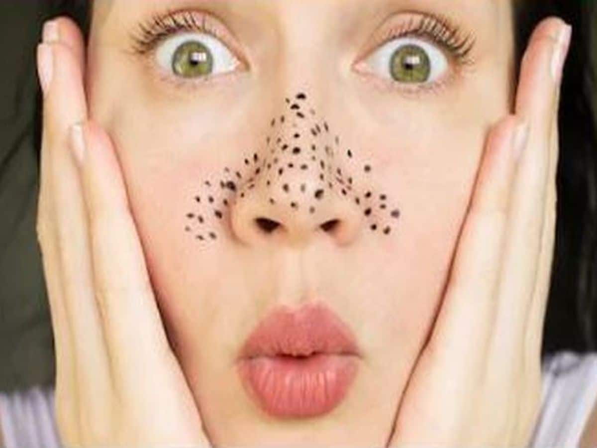 How Do You Get Rid Of Deep Rooted Blackheads TheHealthSite