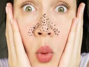 How Do You Get Rid Of Deep-Rooted Blackheads?