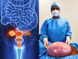 7.5 Kgs Ovarian Tumor Removed From 43-year-Old Lady; Signs You Should Look Out For
