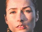 विटिलिगो (Vitiligo)