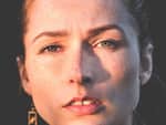 विटिलिगो (Vitiligo)