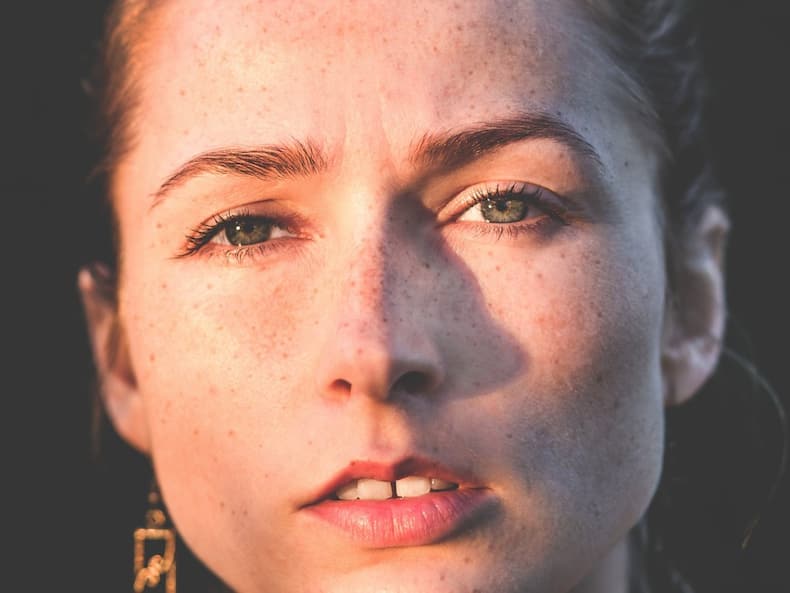 vitiligo