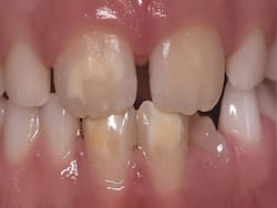 Why Does Your Child Have Chalky Teeth?