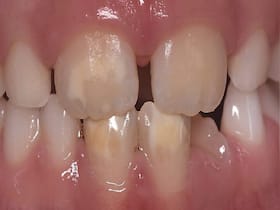 Why Does Your Child Have Chalky Teeth?