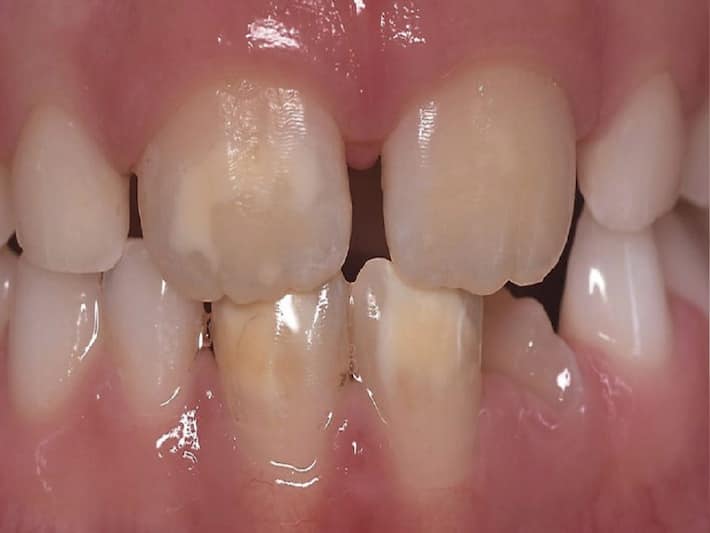 Chalky Teeth Causes, Treatment And More